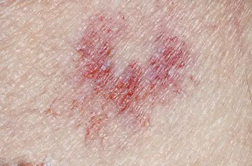 皮肤过敏,查出肝癌,提醒:身体3个"异常"早重视|肝损伤|毒素|棕色_网易