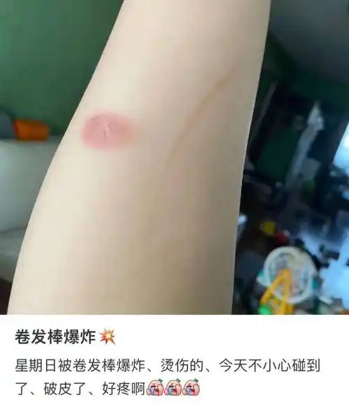 卷发棒竟然爆炸,女子手臂烫伤!