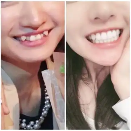 深圳牙科医院科普丨你的虎牙需要做牙齿矫正吗