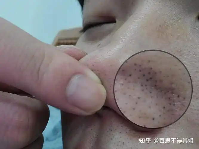 我鼻子上的黑点,是黑头吗? - 知乎