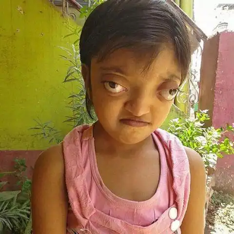 syndrome),头骨过早融合以致眼窝很浅,眼睛突出以及无法聚焦同一方向