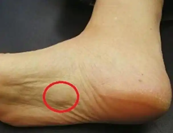 因为足底筋膜炎非常常见,足底筋膜是连接脚后跟和脚趾的组织带,因此不