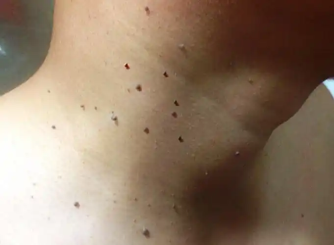 脖子腋下长的"小肉粒"是什么?能用手抠掉吗?若你也有,要注意