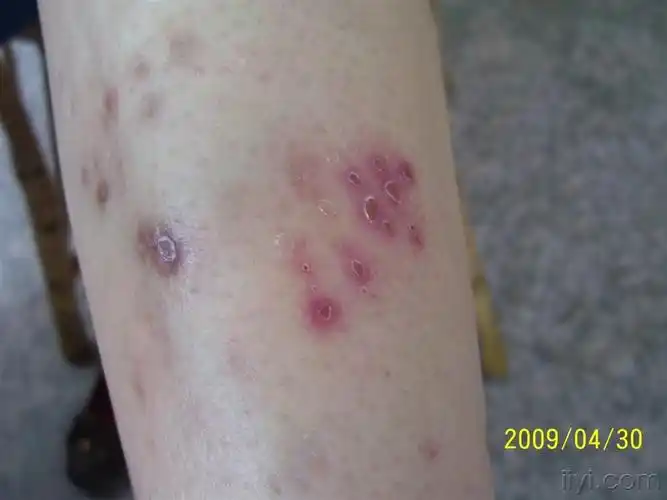 糖尿病病史5年 - 皮肤及性传播疾病讨论版 - 爱爱医医学论坛