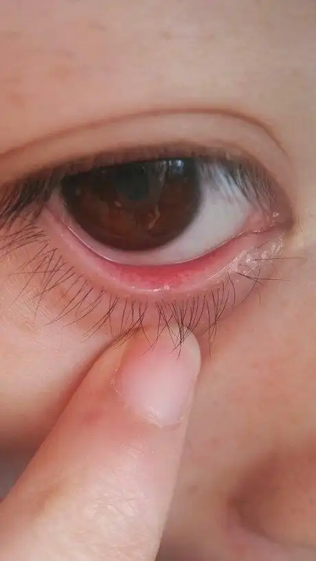 我的眼睛今早下眼睑内有个小白点,请问怎么回事,谢谢