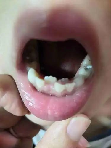 孩子7周岁,双排牙,怎么操作?