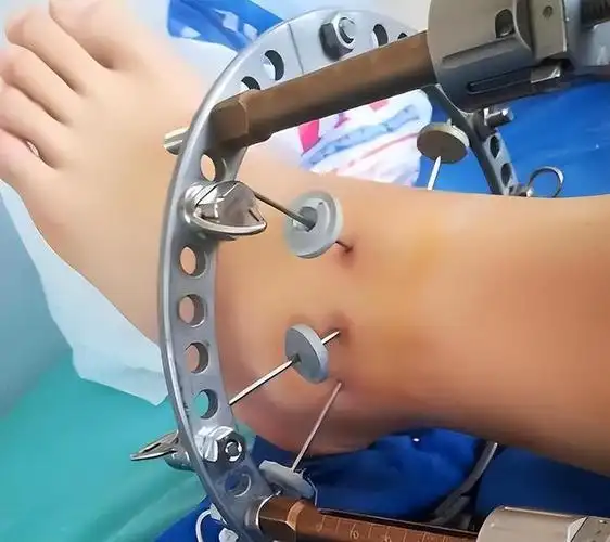 切断双腿骨头增高7厘米,结局如何|手术|医生|截肢|治疗_网易订阅