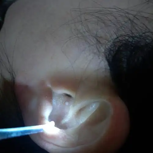 妈妈耳朵里长个白色圆粒,有知道是什么的么