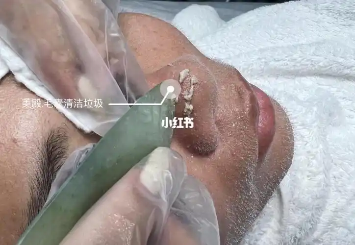 毛囊清洁_清洁_谷埠街攻略_毛囊清洁术_美妆_护肤_护肤其他