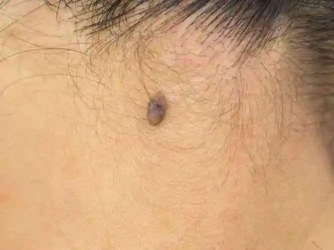 脖子上长的小肉粒可能是丝状疣