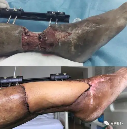医院手足外科就接诊了一位从缅甸回国治疗的右小腿濒临截肢的重症患者