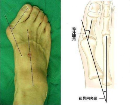 大脚骨如何兼顾美学标准?