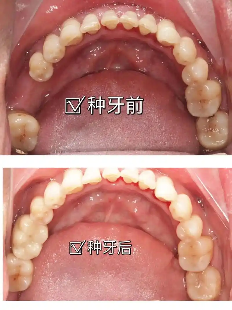 种植牙,人类的第三副牙齿,最近我们门诊种植修复的案例,种的是 - 抖音