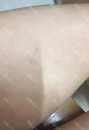 6月14号,一个月了,感觉大腿内侧淤青退了点,但是_圈子-新氧美容整形