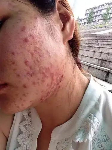 【实拍】痘痘,闭口,黑头,肤色黑,暗沉,战痘六.