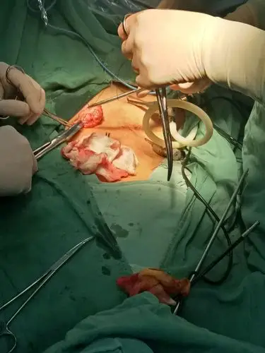 腹腔镜下直肠癌根治术