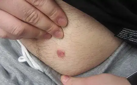 什么是点滴状银屑病点滴状银屑病恢复期照片