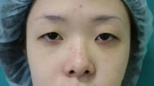 眼睑皮肤松弛(眼皮松弛下垂怎么办?)-综合百科 - 深圳生活网