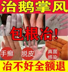 手癣膏治疗手足藓鲜真菌感染汗孢疹脱皮干裂水泡止痒鹅掌风中药膏