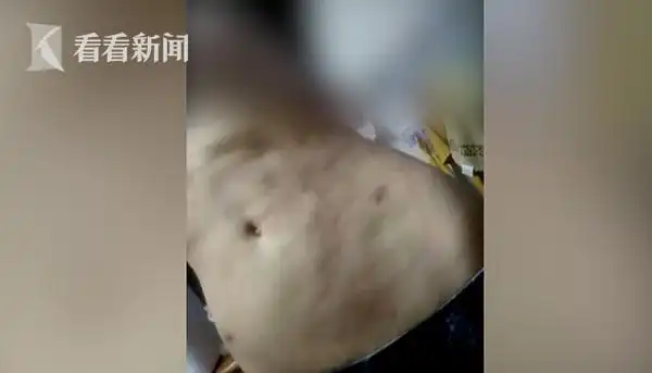 女孩抽脂瘦身肚皮却成橘子?备受打击患上抑郁症