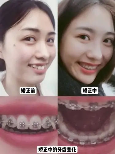 矫正坐标:北京 虎牙是很常见的牙齿问题,有一部分宝宝只是两颗牙齿