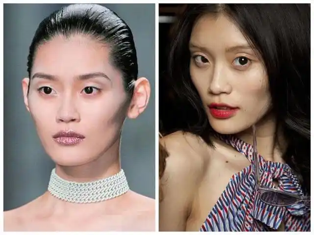 自体脂肪填充是永久的吗对比舒畅奚梦瑶填充效果就知道了