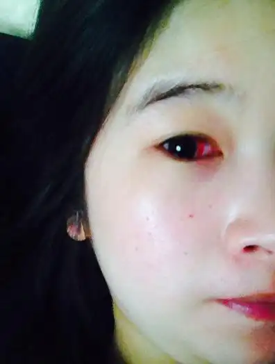 大 这两天发现眼球里都是血一样 但是不疼不痒的 医生说是上火上的