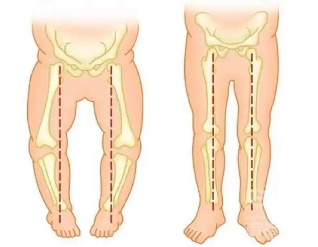 宝宝走路内八字,外八字怎么办,有纠正的方法吗|育儿知识|糖糕妈妈育儿