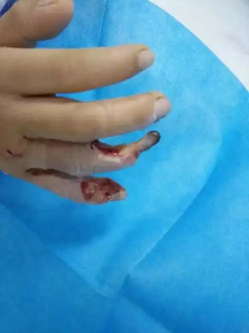 南宁10岁男童被截肢,只因为触碰了每个小区都有的这个东西!