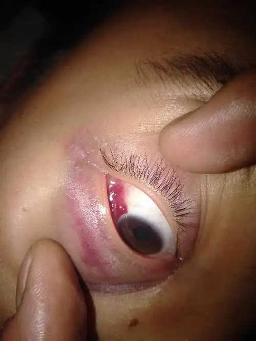 眼睛肿了,眼球也肿了怎么办?