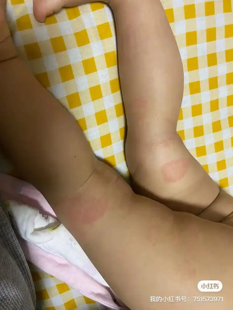 初战告捷! #过敏 #过敏性湿疹 #大战湿疹 #皮肤问题 # - 抖音