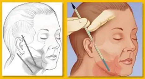 20191215面部拉皮能维持多久一次小切口除皱手术可以维持五年吗