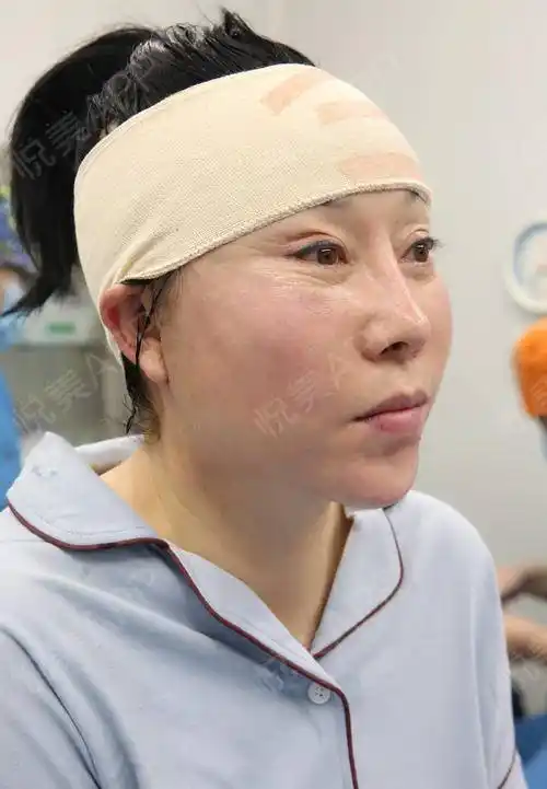 小切口手术提升术后1天_埋线提升术后1天_拉皮手术提升术后1天_紧致