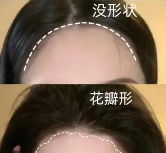 发际线后移怎么办发际线高就丑吗植发际线大概需要多少钱