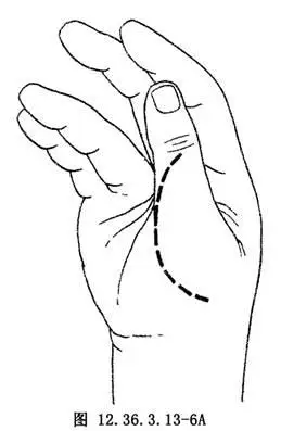 环指浅屈肌腱移位重建拇指对掌功能