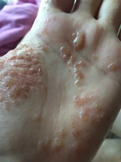 我爸爸得了湿疹,大小医院都去过,就是看不好.求助