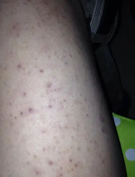 大腿上长了很多痘痘,红的,不疼,如何消除?