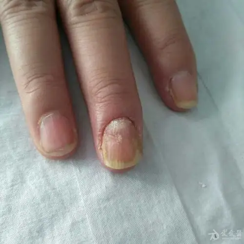看图诊断甲真菌感染