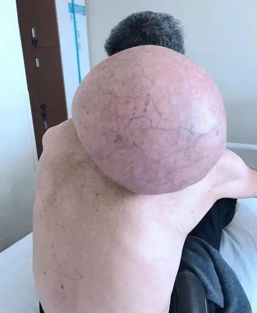 脂肪瘤会发展成脂肪肉瘤吗 ,50多岁的程女士一直在外打工,这几年她的