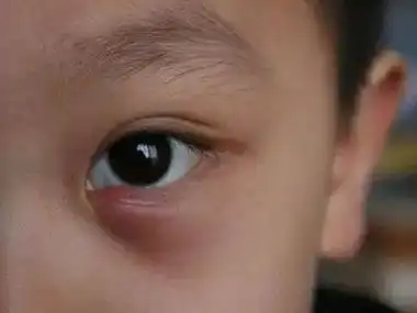 眼睑脓肿下眼睑上有一个红疙瘩图.jpeg
