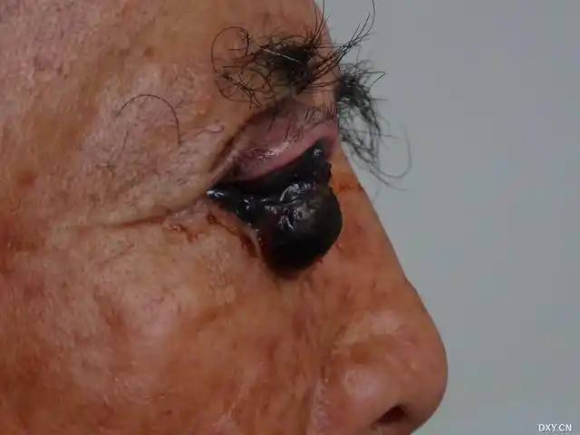 【现病史】 4个月前患者右上睑鼻侧皮下发现一绿豆大小包块,曾于当地