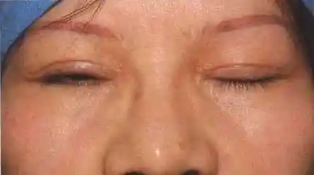 割双眼皮有什么危险吗