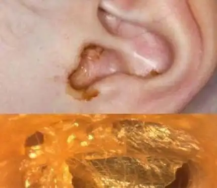 耳朵内常有脓液流出,一定要经常将耳内的脓液清洗干净.