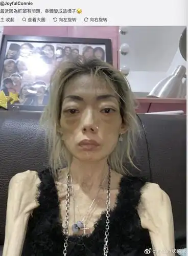 郭永淳前妻罕露脸精神尚可,仍暴瘦如柴,靠拍卖名牌赚钱筹医药费