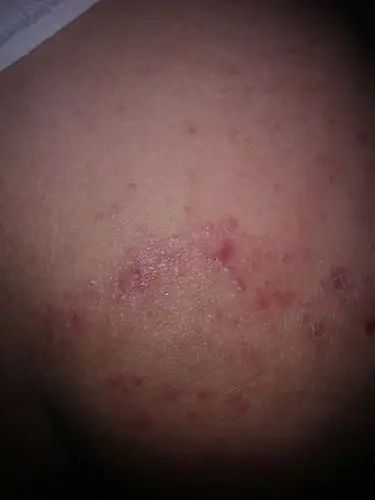 屁股上有些红色的突起,不痛,但是很痒,求看看是什么病