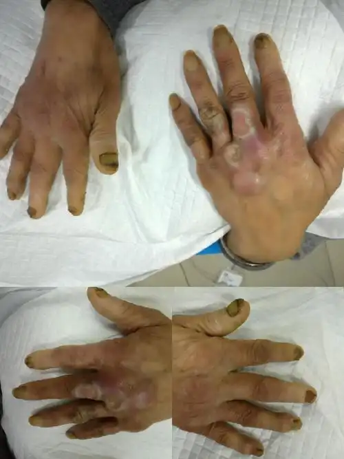 特殊感染一例(慢性溃疡讲座第20讲) 写美篇刘某,因双手甲周红肿溃烂2