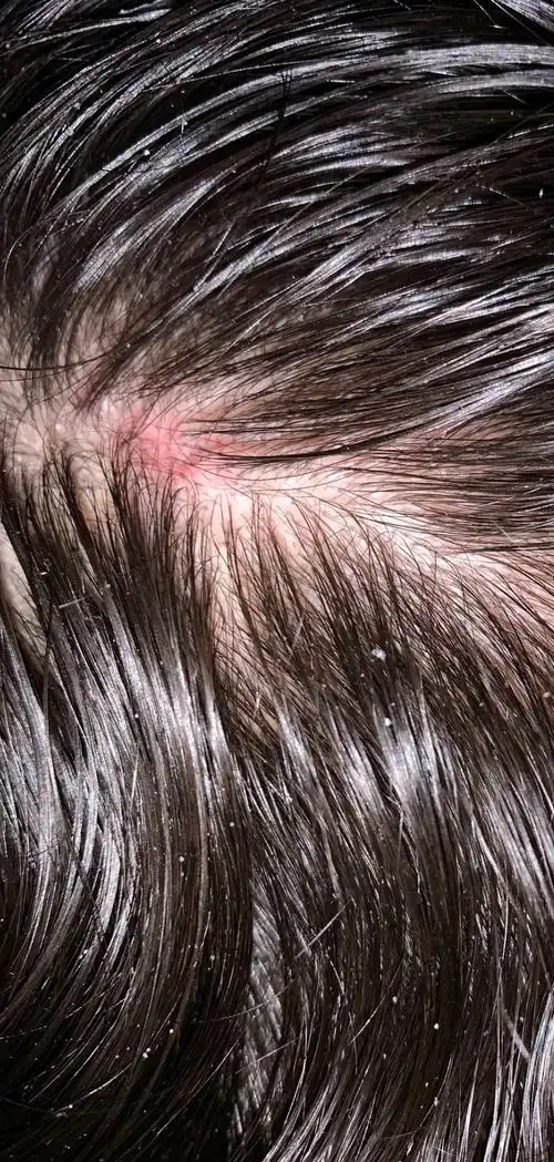 头皮又痒又油脂溢性皮炎自救整理