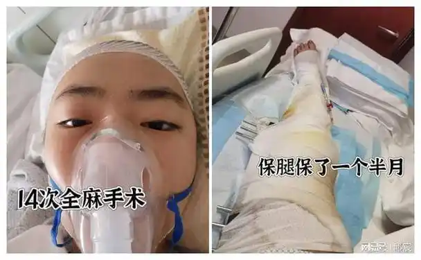 闺蜜超速驾车致车祸后,女孩残疾又被分手|截肢|假肢|残肢_网易订阅