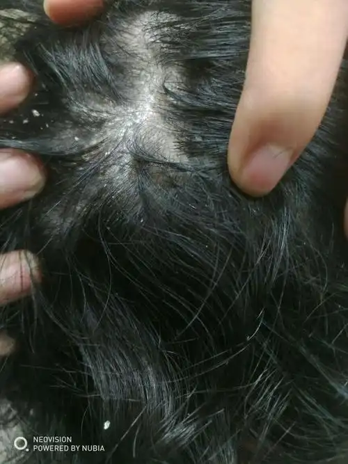 头皮问题,来个大神