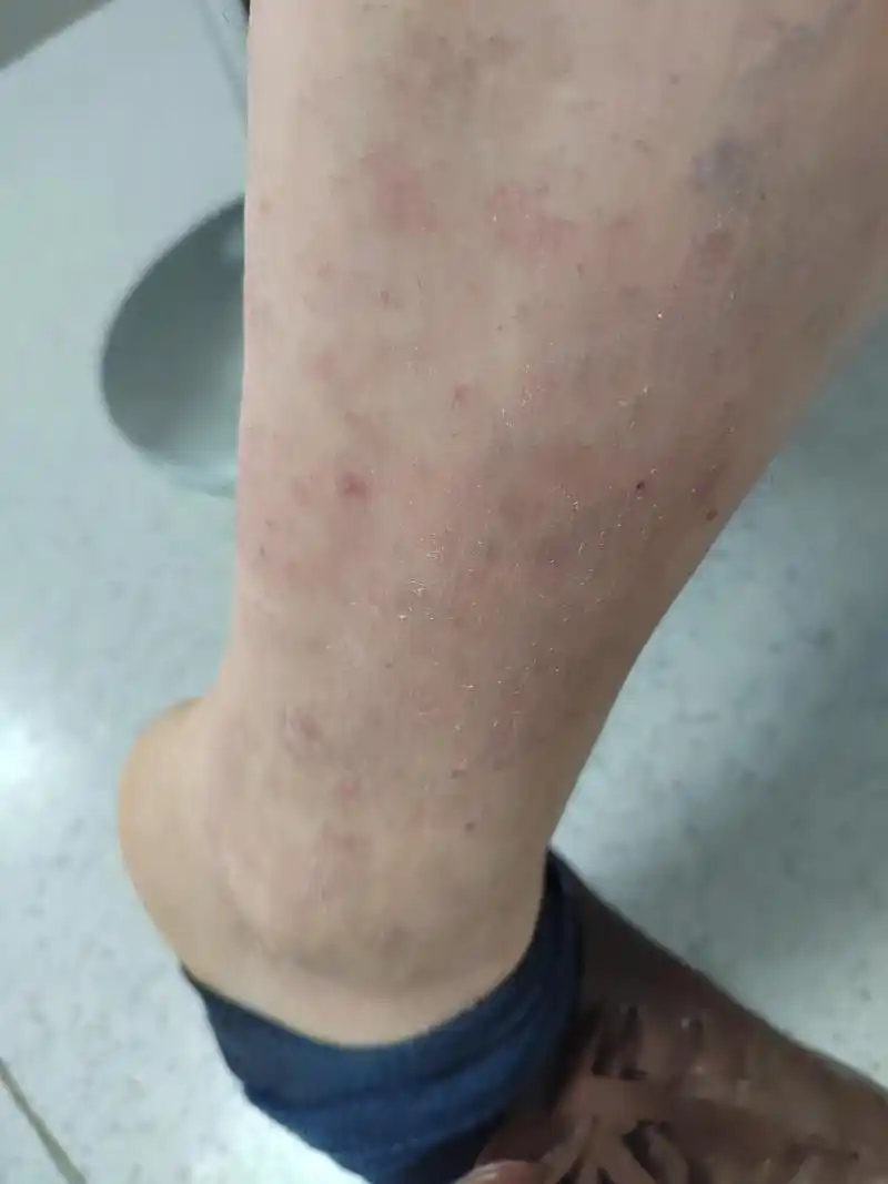 小腿部位的特应性皮炎症状使用生物制剂治疗后皮炎症状消退很快#解决
